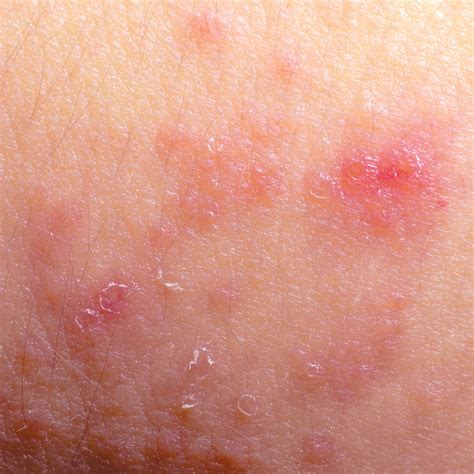 Pink, purple-red, or bruised skin. . Pictures of inflammatory breast cancer rash